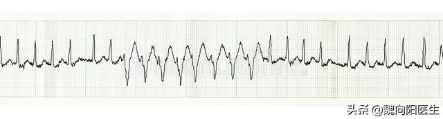 年纪轻轻得脑梗是什么原因,年纪轻轻就脑梗