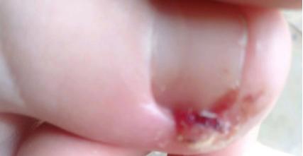 小脚趾甲太短会得甲沟炎吗,脚趾甲剪得过短避免甲沟炎