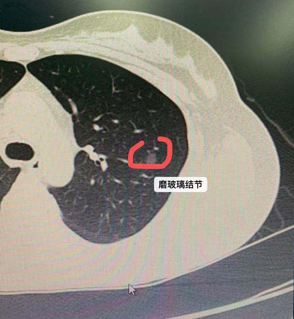 肺部结节半年增大1毫米是肺癌么,肺部有1.11cm结节是肺癌吗