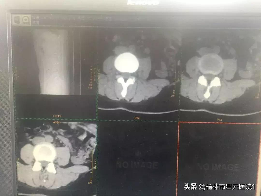 榆林佳县治疗腰椎间盘突出,榆林腰椎间盘突出最有效治疗
