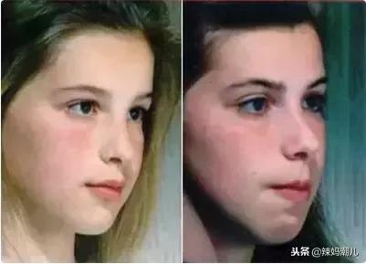 凸嘴的坏习惯,龅牙导致的嘴凸应该怎么改善