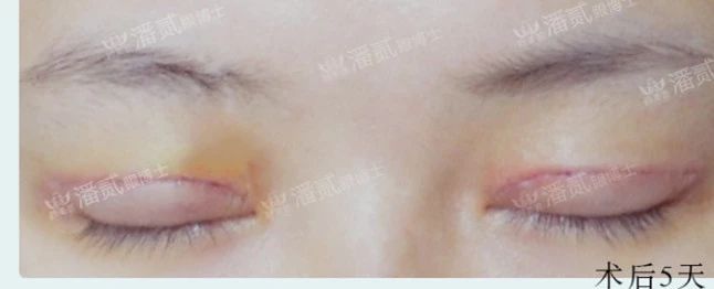 双眼皮失败眼角处有褶皱,双眼皮失败后闭眼痕迹
