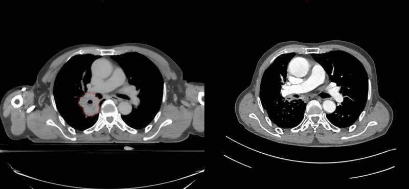 商陆治疗肺癌晚期,硼中子治疗晚期肺癌