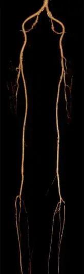 糖尿病足手术后又坏死怎办,糖尿病足部溃烂截肢手术