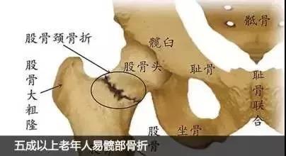 伤害老年人的第三大杀手！家中有老人跌到，髋部骨折该如何处理？