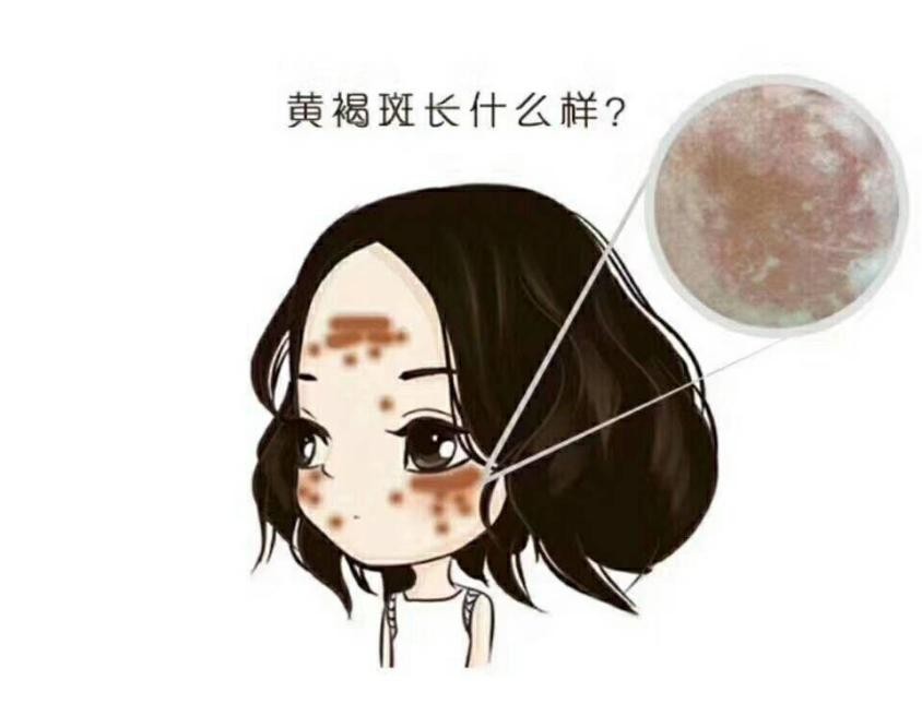 褐斑是怎么引起的,怎么预防长褐斑