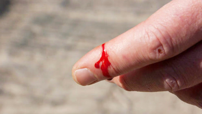 手划破皮了血流不止怎么办,皮肤一划破就流血不止怎么回事