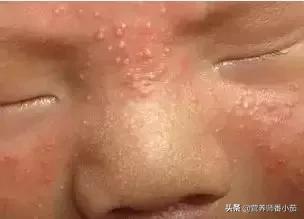 粟粒疹宝宝,宝宝红斑丘疹鉴别图谱