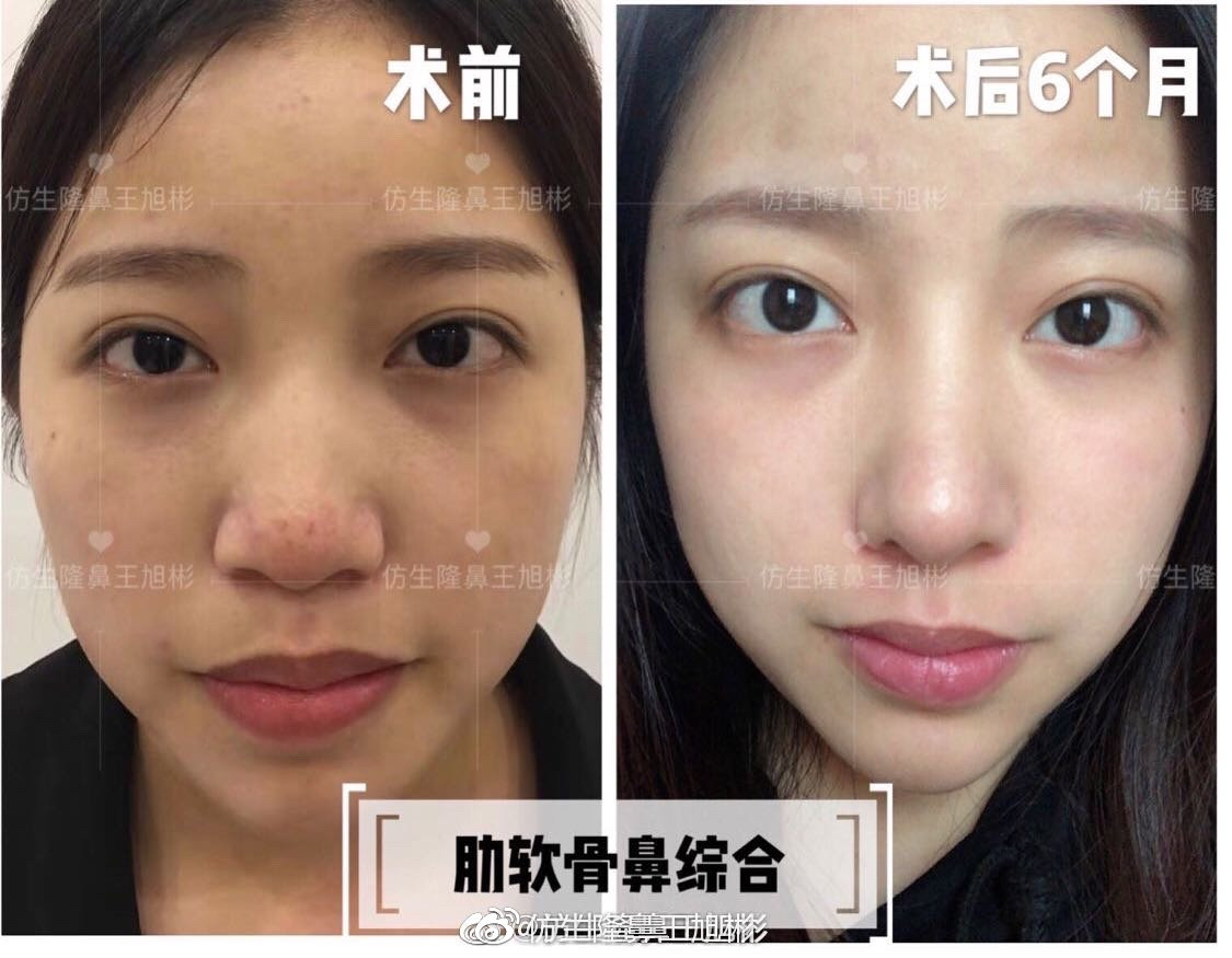 大宽朝天鼻整形过程,窄鼻子如何通过鼻整形来矫正