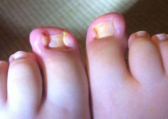 啃指甲拔倒刺可能会引起甲沟炎,啃手指啃出甲沟炎