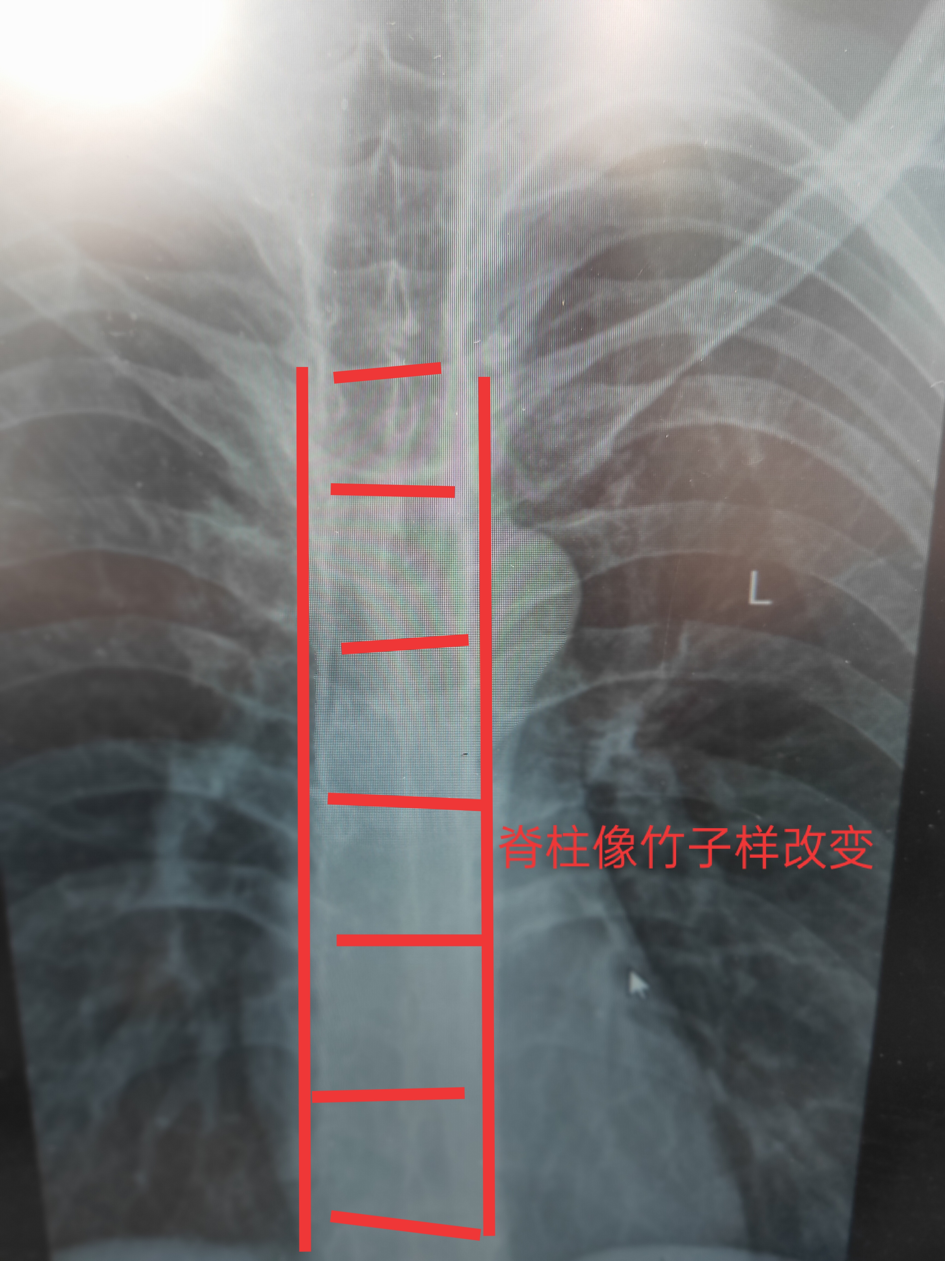 强直性脊柱炎能引起腰痛和腹痛吗,强直性脊柱炎引起的腰痛怎么缓解