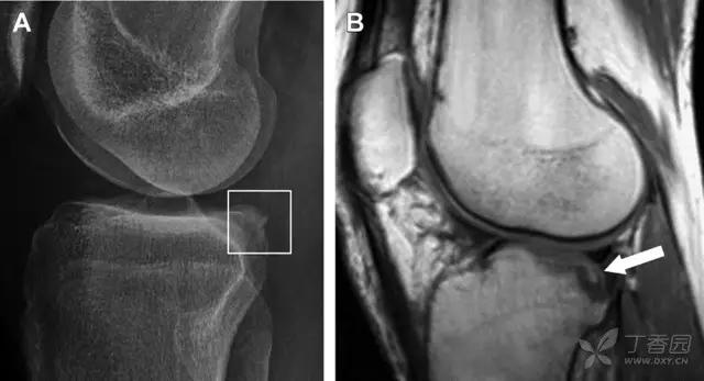 值夜班急救措施,放射科容易漏诊的骨折