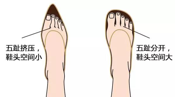 脚趾嵌甲怎么修剪,脚趾嵌甲严重长肉芽自己如何处理