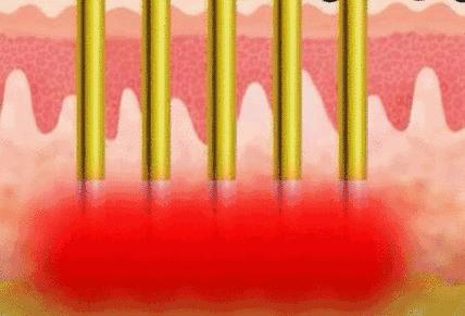 医美最应该做的项目有哪些,最常见的医美项目