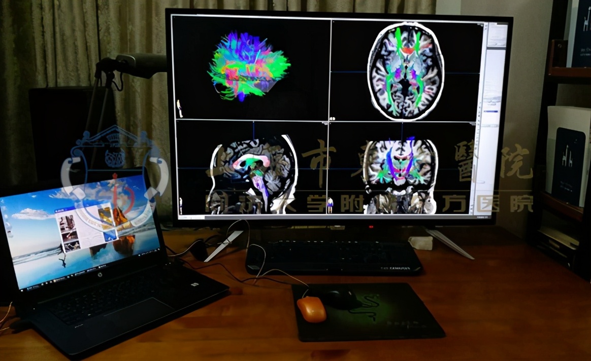 异样思维,偶发性精神分裂如何治疗