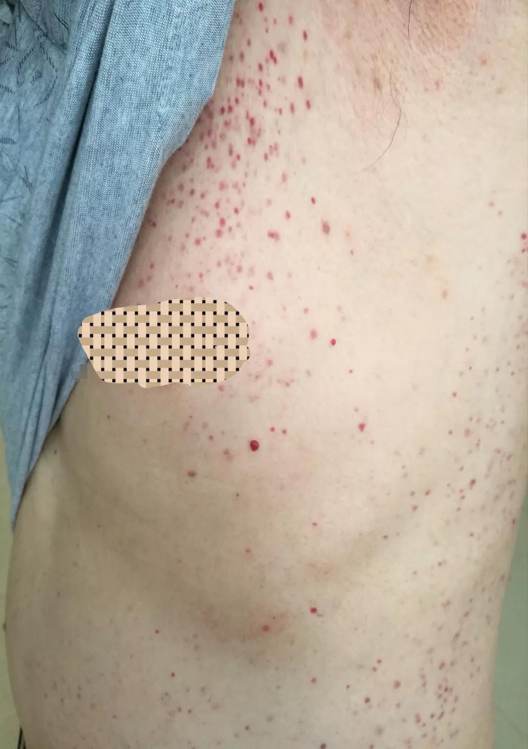 色素性紫癜性皮肤病是啥,色素性紫癜性皮肤病是什么