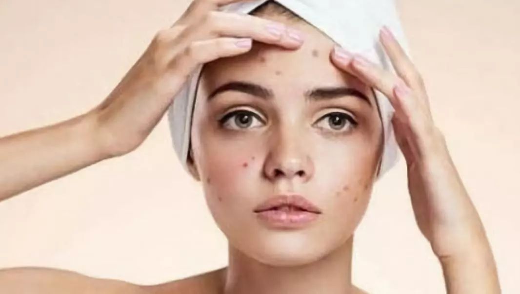 牙膏洗脸祛痘痘好吗,牙膏洗脸可以淡斑的方案