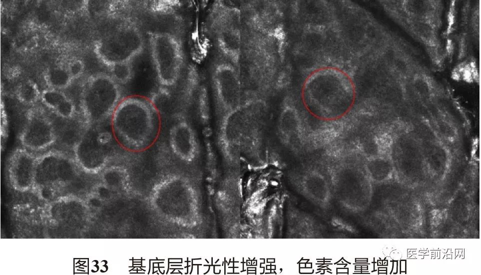 皮肤共聚焦显微镜能查什么,皮肤镜和共聚焦显微镜