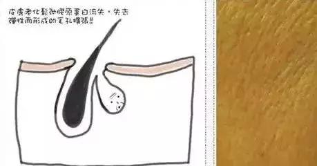 皮肤粗糙毛孔粗大,毛孔粗大黑头顽固