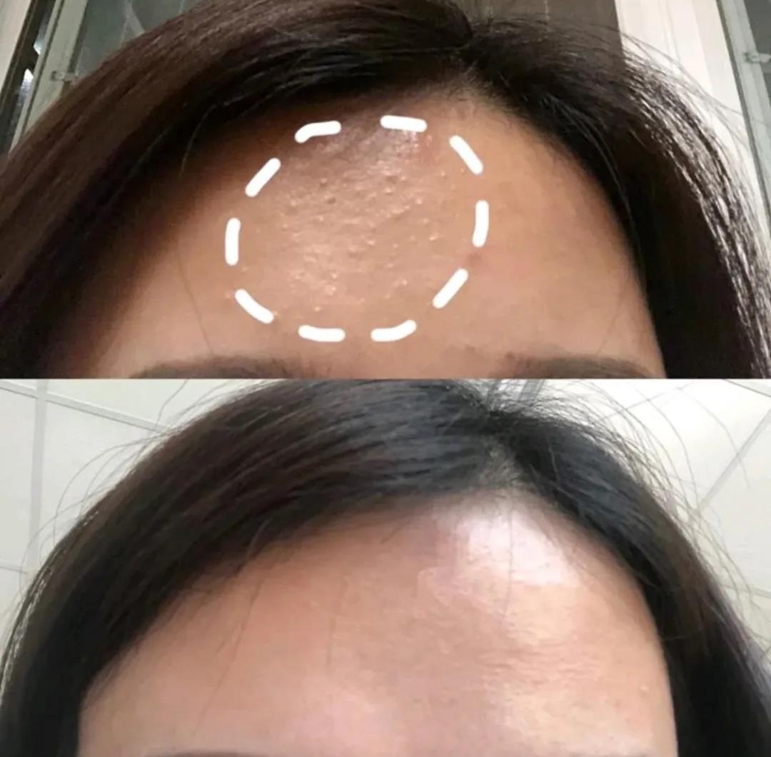 闭口怎么才能有效清理,闭口怎么处理最有效