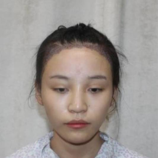 植发后取发区多久恢复正常,三级脱发植发能恢复到原来吗