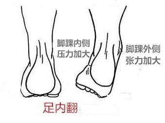 足内翻导致足弓疼,足内翻会导致什么腿型怎么改