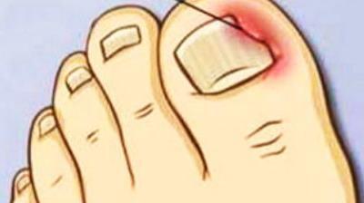 啃指甲甲沟炎,拔肉刺引起甲沟炎