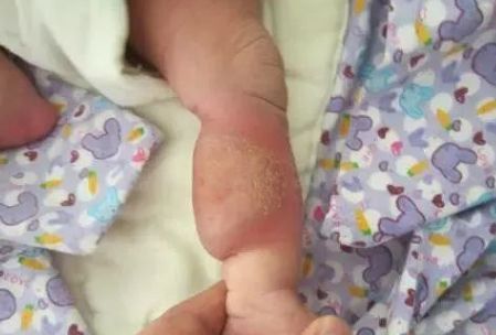 宝宝有一块红胎记是血管瘤吗,新生儿红胎记正常吗