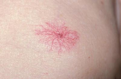 长红痣是肝病的标志吗,身上有红痣肝病有多严重了