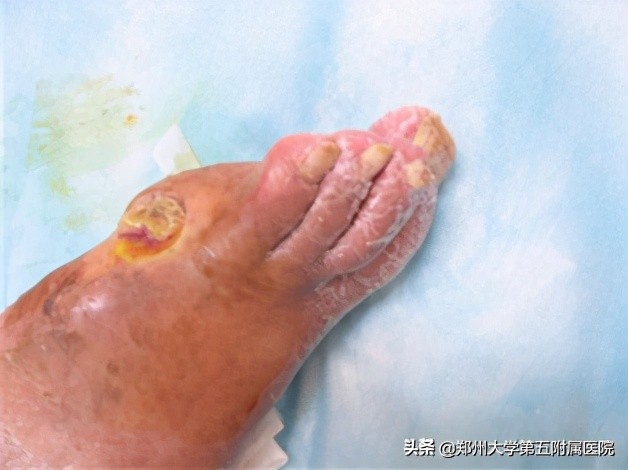 老茧疼痛怎么去除,去除手部老茧