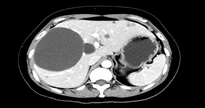 发现肝脏实性占位后做什么检查,肝脏阴影或占位有可能是哪些病