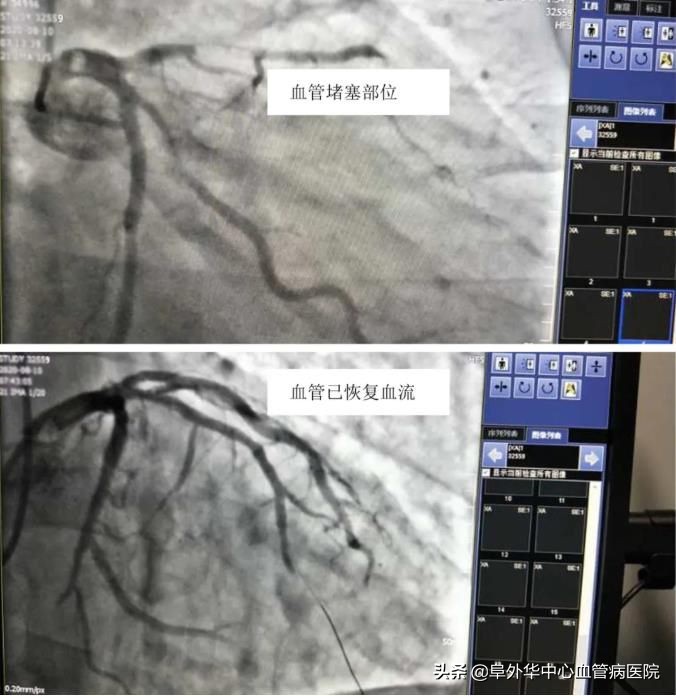 酒后心电图,酒后做心电图