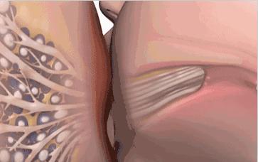 「哺乳问题」乳头皲破咋办？解决方法来了