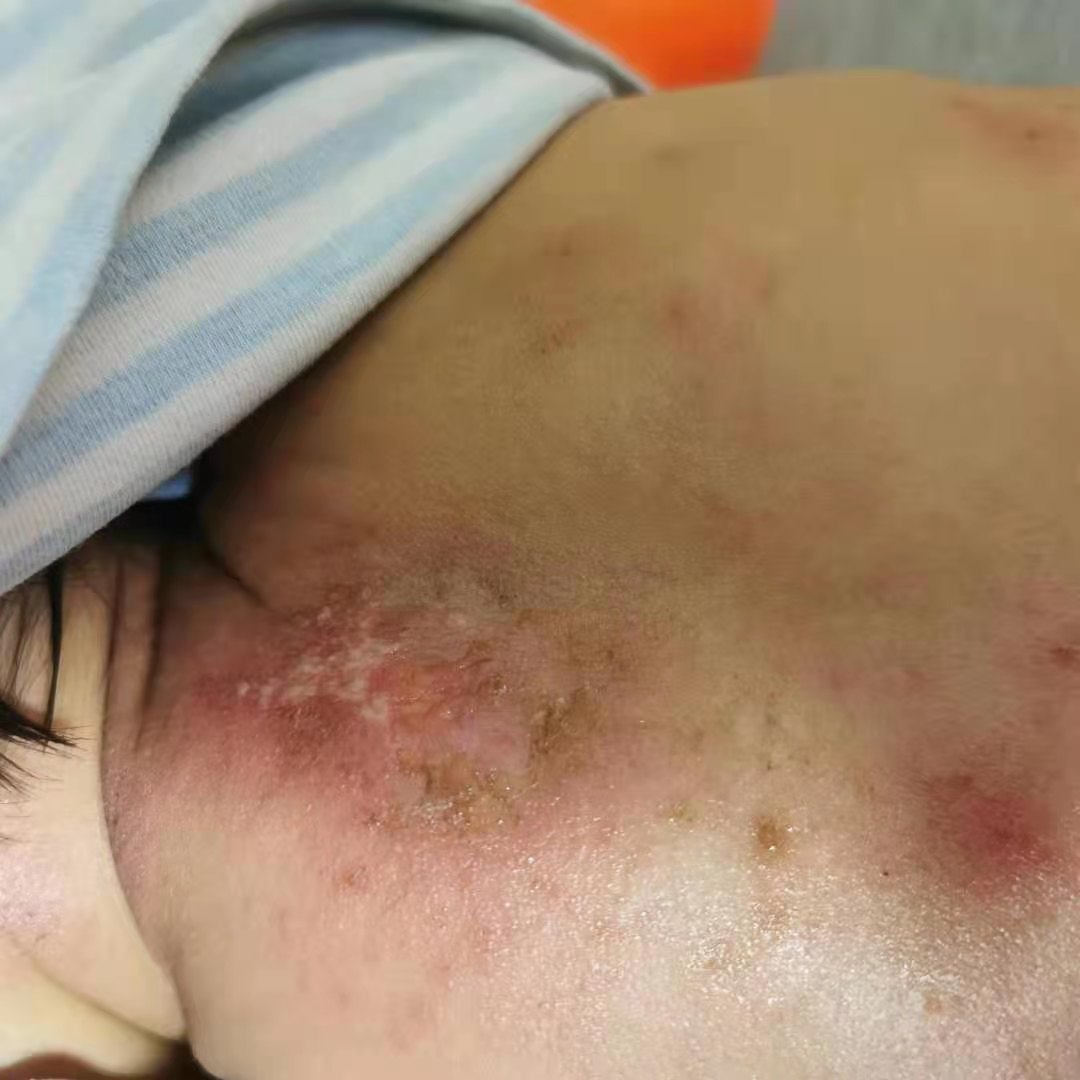 传染性软疣儿童怎么治可以断根,儿童脸上长了传染性软疣怎么办