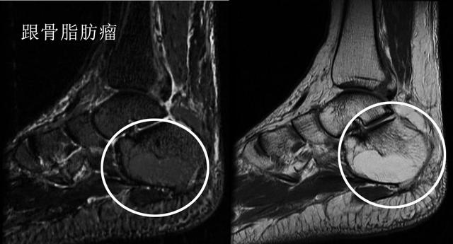 足跟疼痛教你一招百试百灵,早起落地脚疼