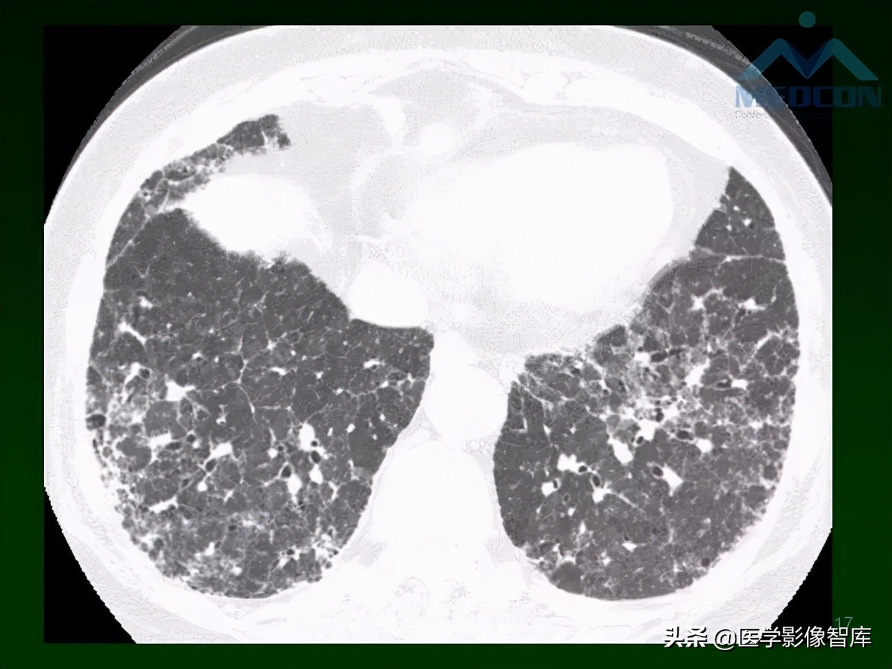 肺弥漫性网状影,两肺小叶间隔增厚可见网状模糊影