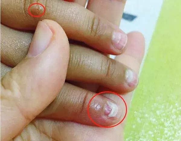 利巴韦林对手足口效果怎么样,手足口病喝利巴韦林