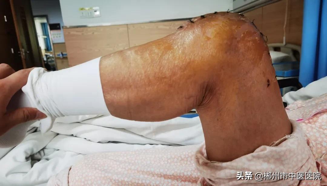 专家支招骨关节炎治疗,膝关节骨性关节炎疼痛怎么治疗