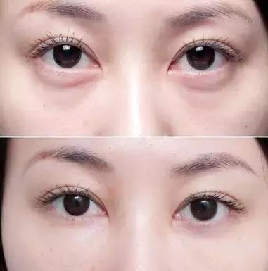 你知道什么是玻尿酸吗,如何快速了解玻尿酸品类