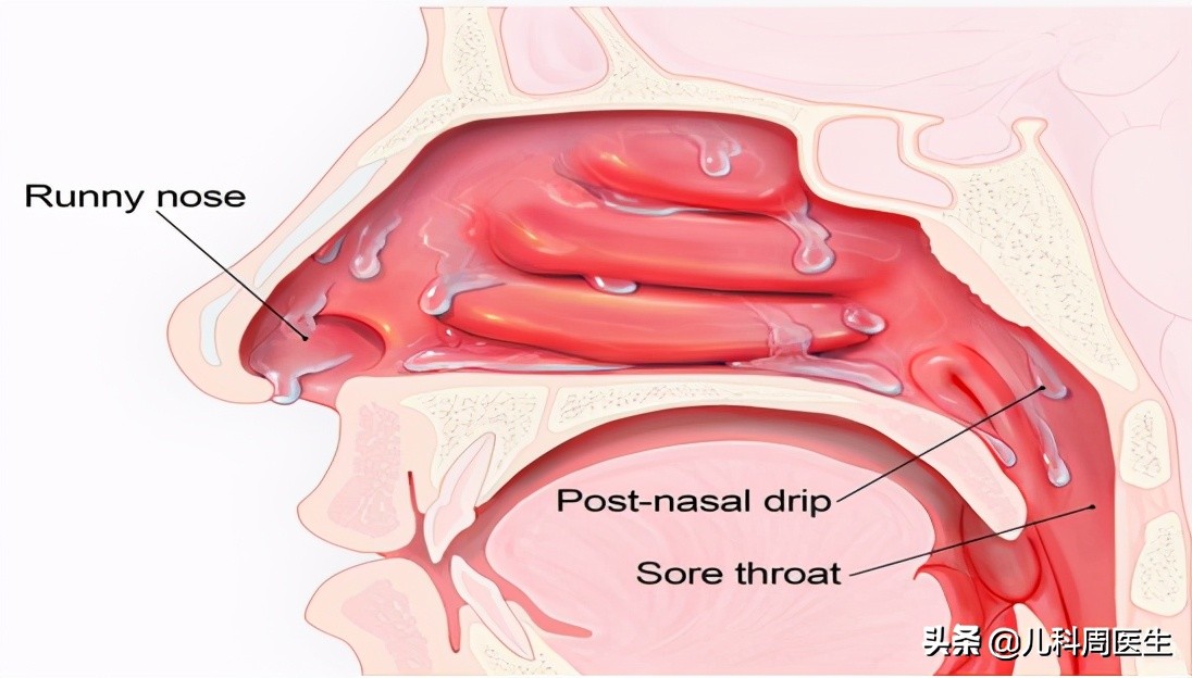 浑浊鼻涕与清鼻涕怎样区分,鼻涕有黑色的东西