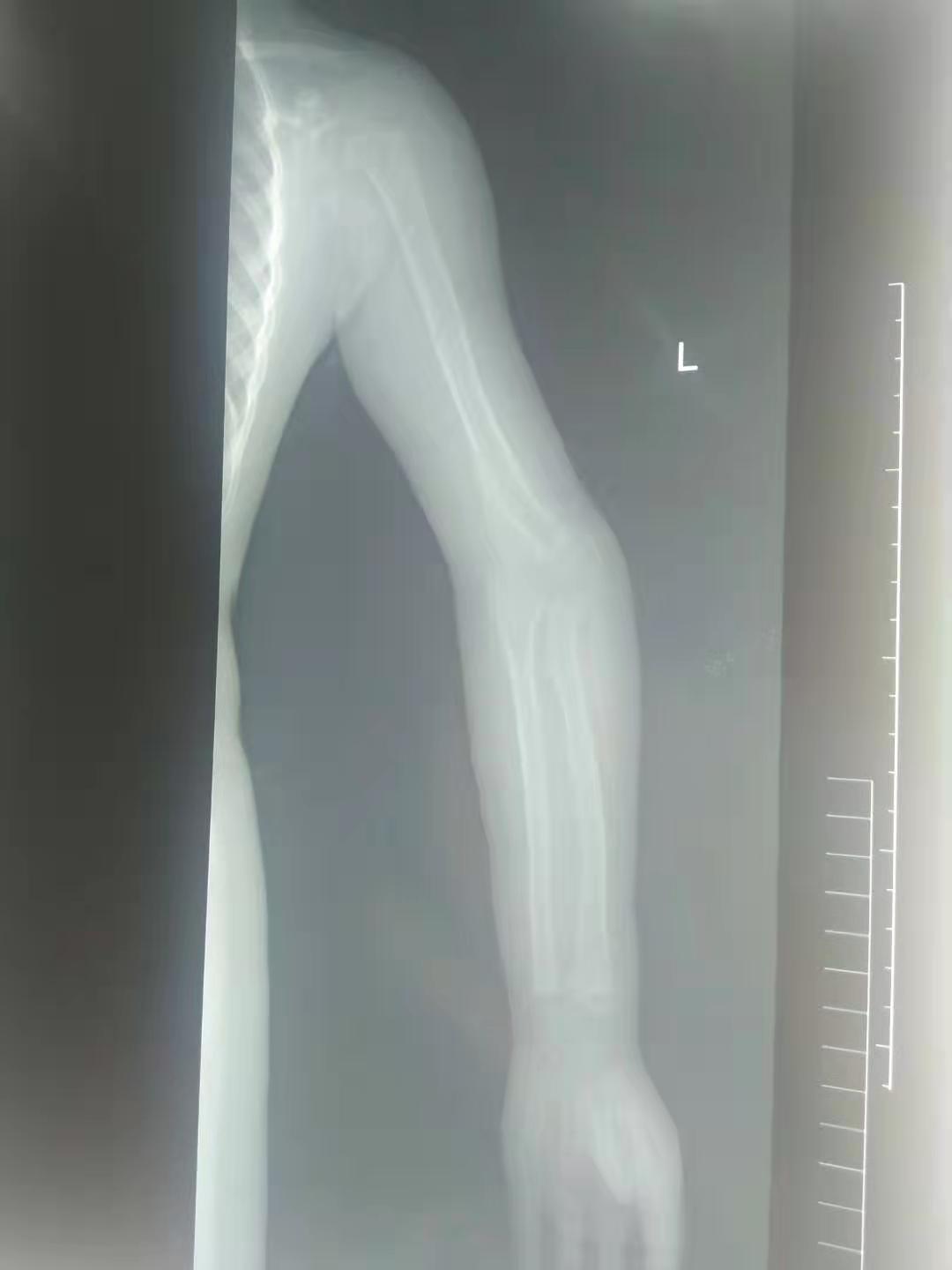 骨折复位错位1.4毫米有影响么,骨折错位一个月还能手法复位吗