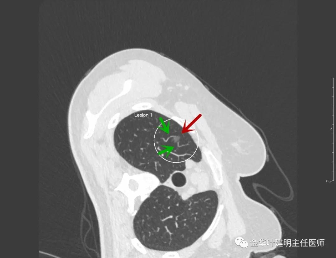 左肺上叶在ct影像上怎么看,平扫ct可以看出肺肿瘤的变化吗