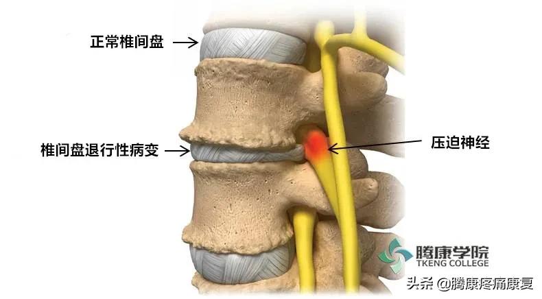 坐骨神经痛什么药能除根,坐骨神经痛的原因与诊疗