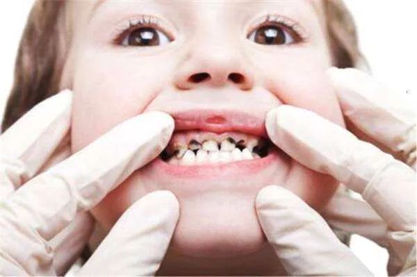 关于孩子长蛀牙的知识误区,3岁孩子牙齿全坏了怎么办