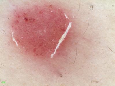 女儿得了银屑病怎么办,宝宝湿疹和银屑病区别