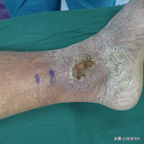 闽东医院开展腔镜下穿通支静脉离断硬化剂治疗老烂腿