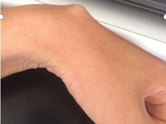 写字写多了手上有个包怎么办,手上无缘无故起个包按着很疼