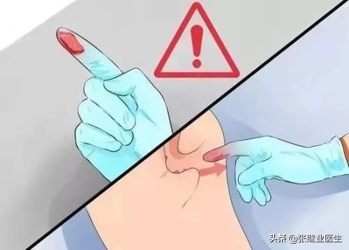 什么情况要做直肠指诊,不需要做直肠指检的有哪些疾病