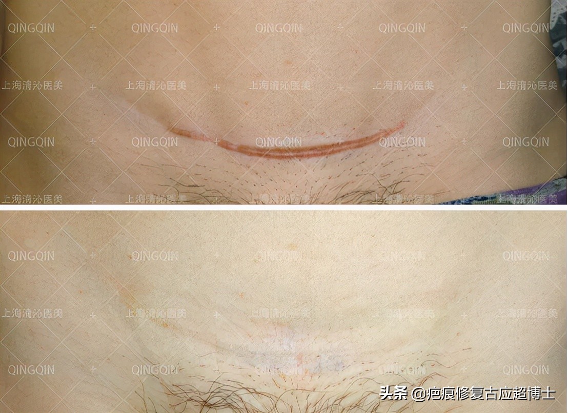 不忘初心，深耕疤痕难题！（匠心筑梦烙印天使）