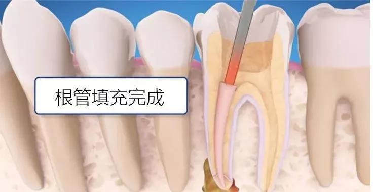 已经有牙洞了怎么根管治疗,牙髓腐烂坏死再做根管治疗会痛吗